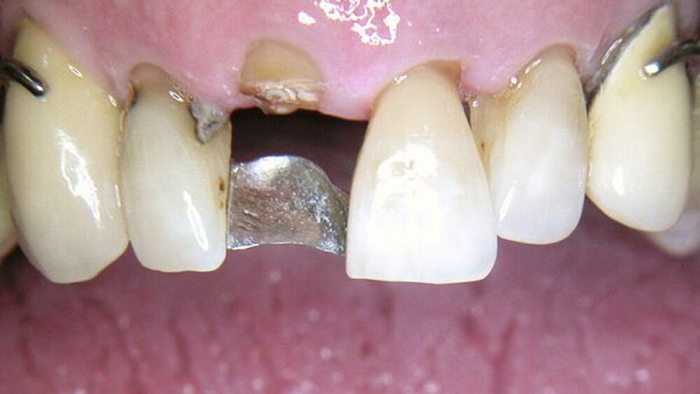 Herausnehmbarer Zahnersatz kann durch einen dentalen Verbinder vorteilhaft erweitert werden, behelfsweise auch unter Einbeziehung der ursprünglichen Zahnkrone. |