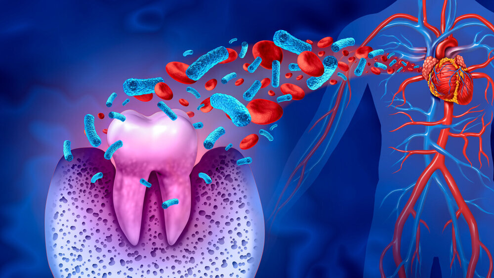 Tooth Decay Disease Wechselwirkung von Parodontitis und allgemeinen Erkrankungen