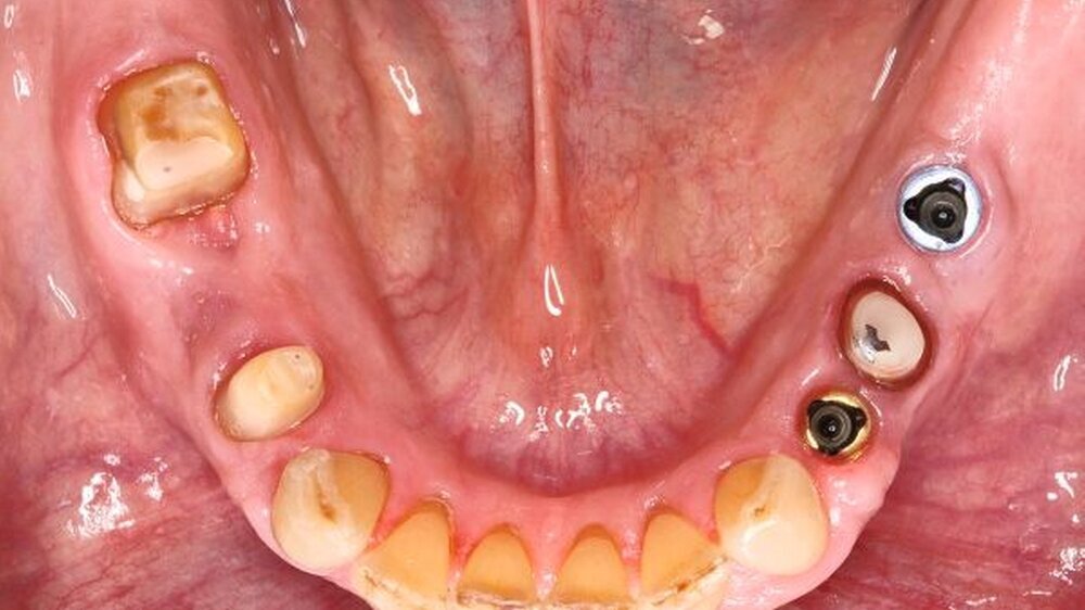 Abbildung 1: Implantate regio 34, 36 Die Zähne 35, 44 und 46 sind für die Aufnahme einer Krone beziehungsweise Brücke präpariert.