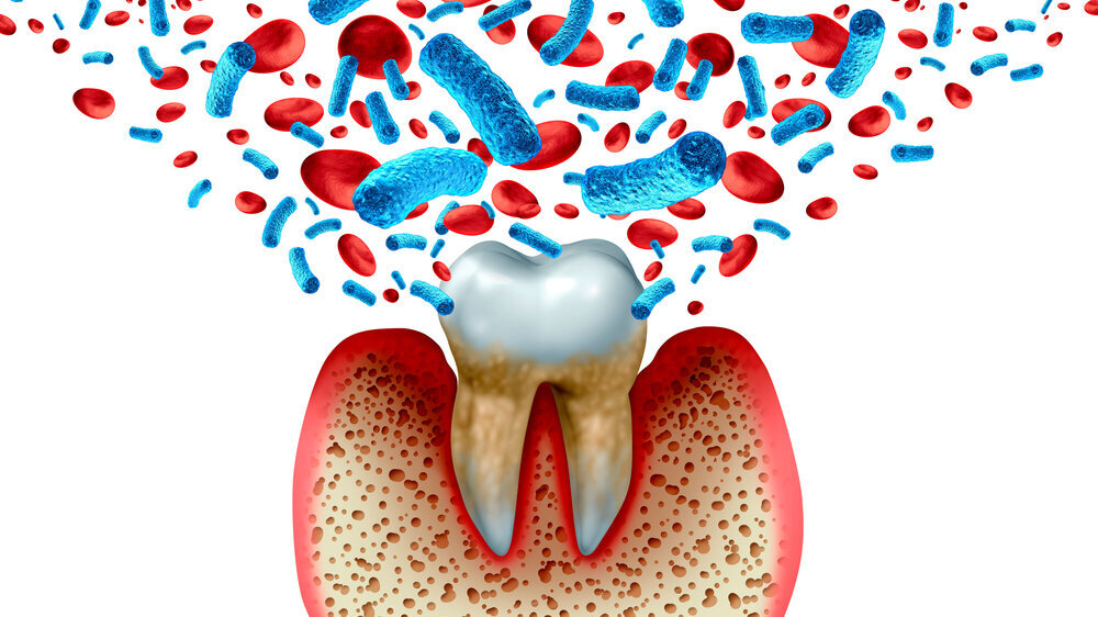 Tooth Decay Blood Bacteria Parodontitis