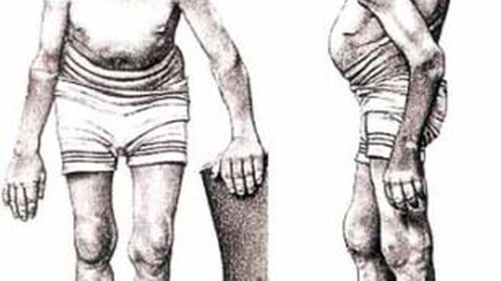 Darstellung eines akromegalen Patienten durch den französischen Arzt Pierre Marie, der 1892 die Akromegalie als einen „abnormalen Spätriesenwuchs“ charakterisierte. Quelle: Von Riesen, Wunderkammern und Somavert®, Hrsg.: Pfizer Pharma GmbH Karlsruh