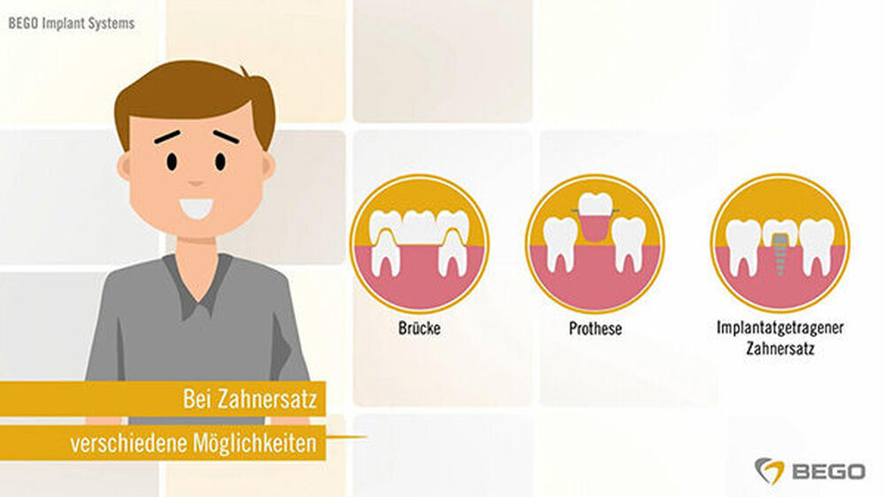 Das neue Video von BEGO Implant Systems beantwortet viele Patientenfragen zum Thema Zahnimplantate.