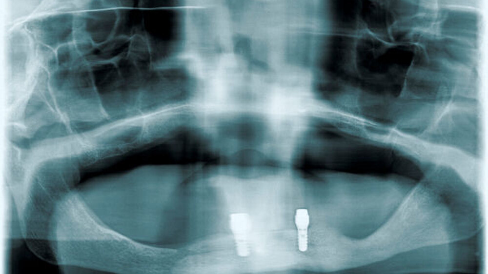 Auch im fortgeschrittenen Alter ist die Osteointegration erfolgreich. | Auch im fortgeschrittenen Alter ist die Osteointegration erfolgreich. |