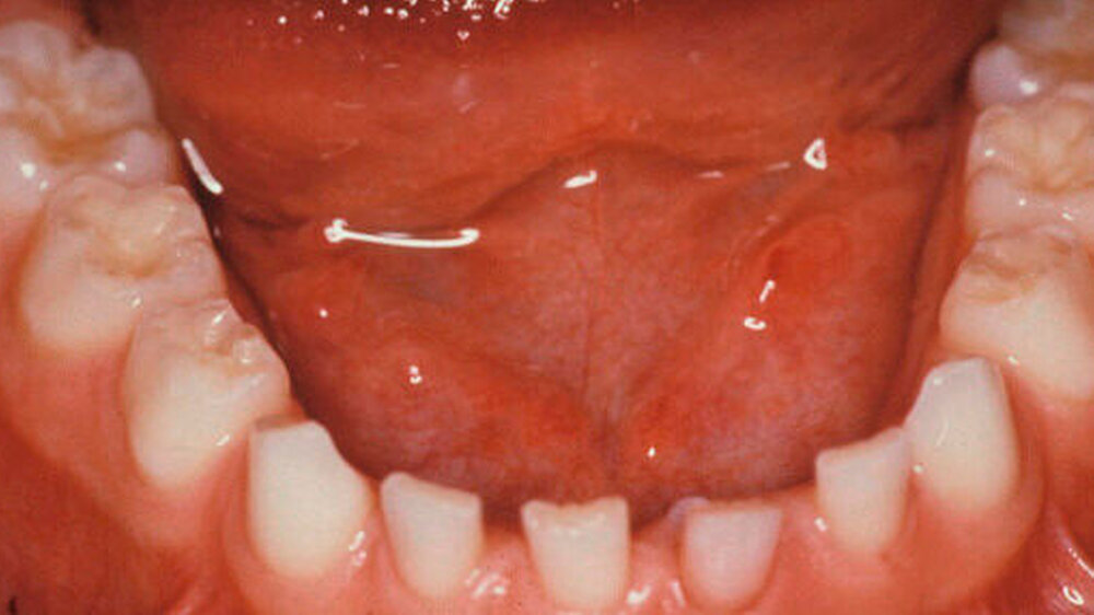 Abbildung 1: Ziel der Kariesprävention mit unterschiedlichen Fluoridierungsmaßnahmen ist die Erhaltung eines naturgesunden Gebisszustands, wobei dies selbstverständlich auch für die Milchzähne gilt.