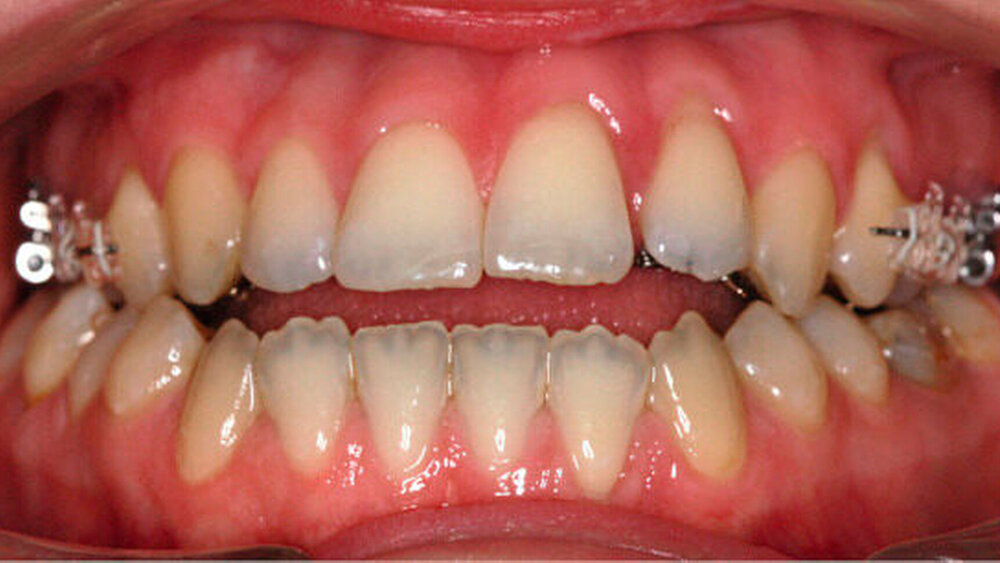 Abbildung 4: Der intraorale Befund von frontal zeigt den gehaltenen frontal offenen Biss und die vestibulär angebrachten Brackets unmittelbar vor der Dysgnathie-Operation. |