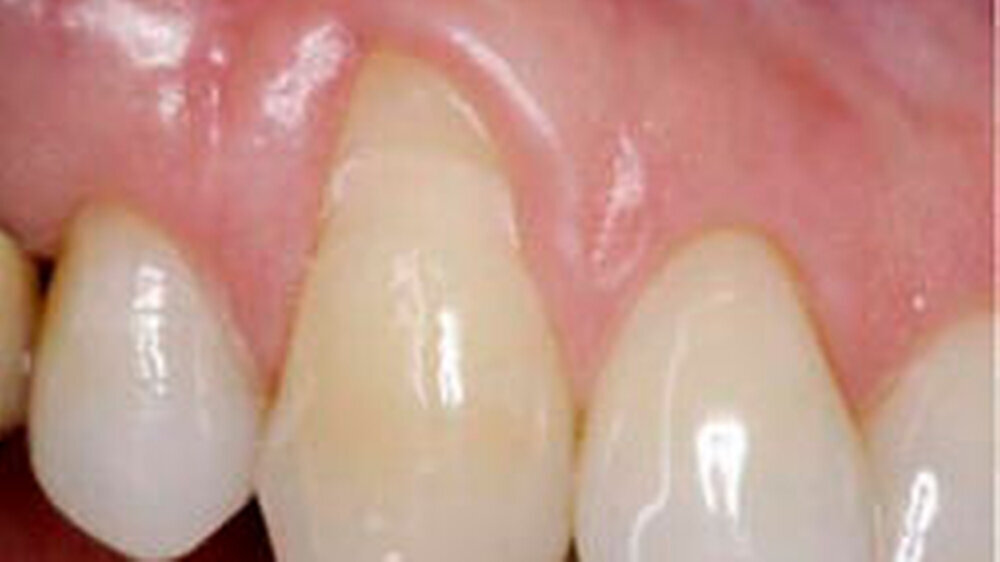 Ausgangszustand einer Rezession mit Dentinverlust in der Wurzeloberfläche am oberen Eckzahn.