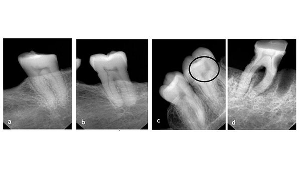 a) rechter 2. Molar mit Stuhlform; \r\nb) rechter unterer 2. Molar zeigt Verengungen und leichte Stuhlform; \r\nc) linker Unterkiefer 2. und 3. Molaren, 2. Molar mit Stuhlform (schwarzer Kreis);\r\nd) rechter 1. Molar mit kariöser Läsion und okklusalem