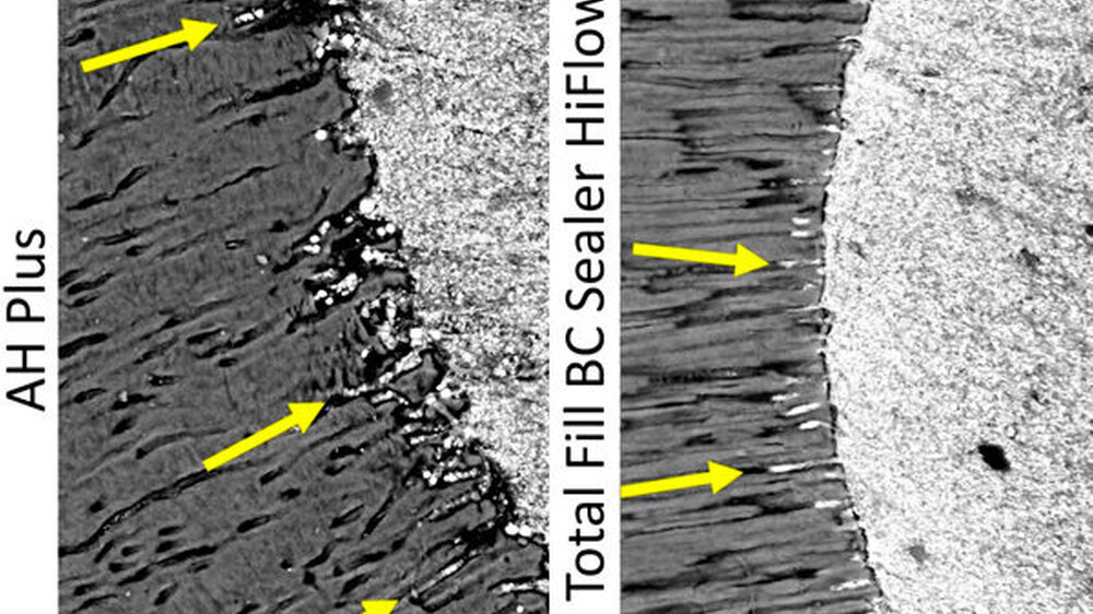 Abbildung 1 (Auszug): Die rasterelektronenmikroskopischen (REM) Aufnahmen zeigen die Eindringtiefe des Sealers (Pfeile) von AH Plus und Total Fill BC Sealer HiFlow nach einer warmen vertikalen Wurzelkanalobturation in 8 mm Entfernung von der Wurzelspitze.