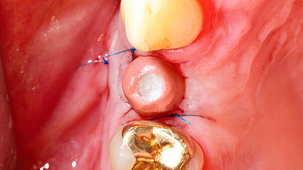 Klinische Situation vier Monate nach Implantation – Freilegung mit Rolllappenplastik (RC Gingivaformer – individualisierbar – Höhe 7 mm, Durchmesser 7 mm – PEEK)