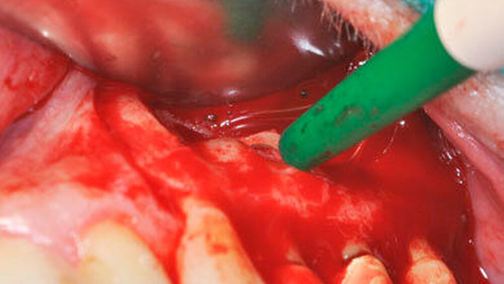 Abbildung 4: intraoperativer Situs nach WSR an 24 und 25 |