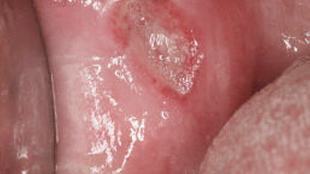 Abbildung 4: Majoraphthe am rechten Planum buccale (Patient weiblich, 26 Jahre) |