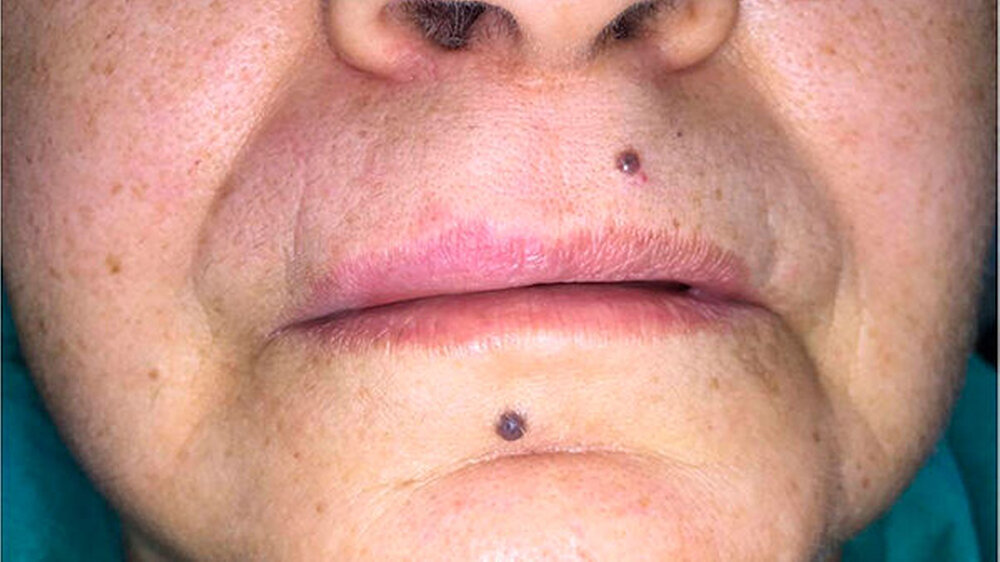 Abbildung 1: Bei der Erstvorstellung war eine leichte Asymmetrie der oberen Lippe sichtbar.