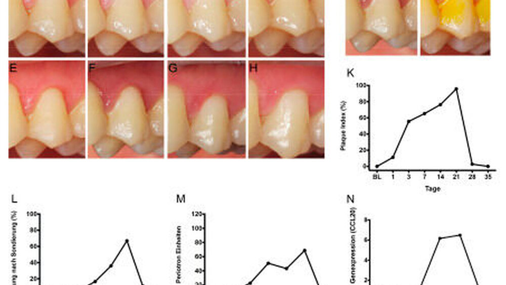 Abbildung 4: Darstellung der klinischen Entwicklung der gingivalen Entzündung anhand des Modells des experimentell induzierten Gingivitis: A: Ausgangssituation (Baseline, BL); B: 1. Tag, C: 3. Tag, D: 7. Tag, E: 14. Tag, F: 21. Tag nach Einstellung aller Mundhygienemaßnahmen für diesen Bereich der Prämolaren. I und J: Darstellung der Plaqueakkumulation nach 21 Tagen, jeweils mit und ohne Einfärbung des dentalen Biofilms: Die Abbildung I zeigt das klinische Bild einer Gingivitis mit den typischen Symptomen wie Schwellung, Rötung und Exsudation. K: Darstellung des Plaque-Index, L: Blutung auf Sondierung im Verlauf der 21 Tage experimenteller Gingivitis und der anschließenden zwei Wochen Resolutionsphase; M: Darstellung der Sulkusflüssigkeitsmenge; N: Darstellung der gingivalen Genexpression des CC-Chemokin-Liganden 20 (CCL20) im Verlauf der 21 Tage experimenteller Gingivitis. |