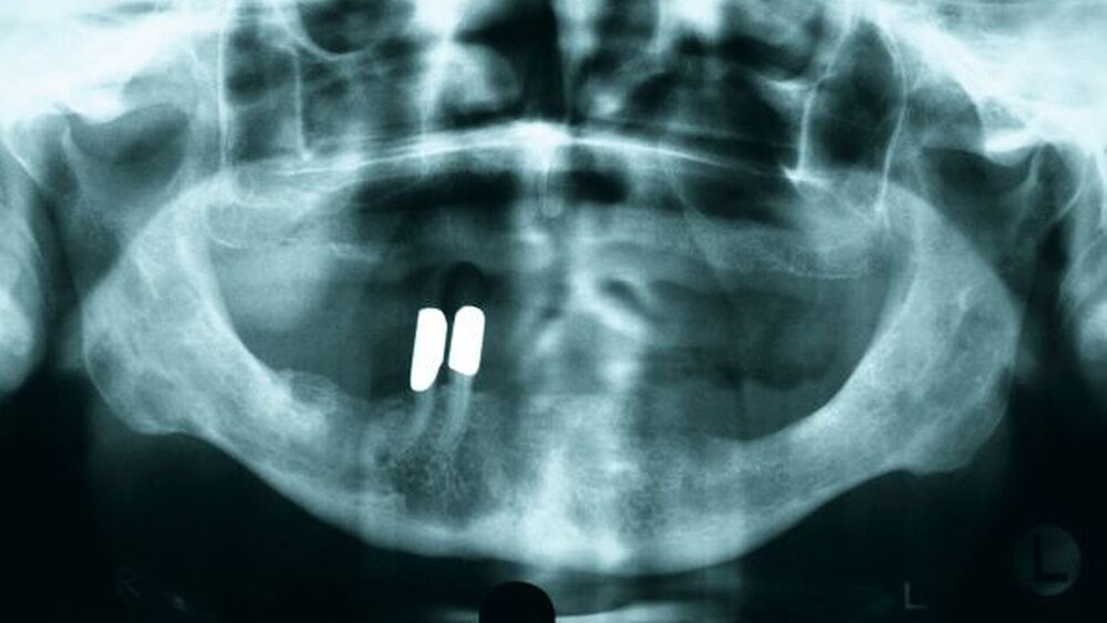 Abbildung 3: OPG von 2004 vor Tumor-OP. |