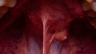 Close-up Tumor im Mund