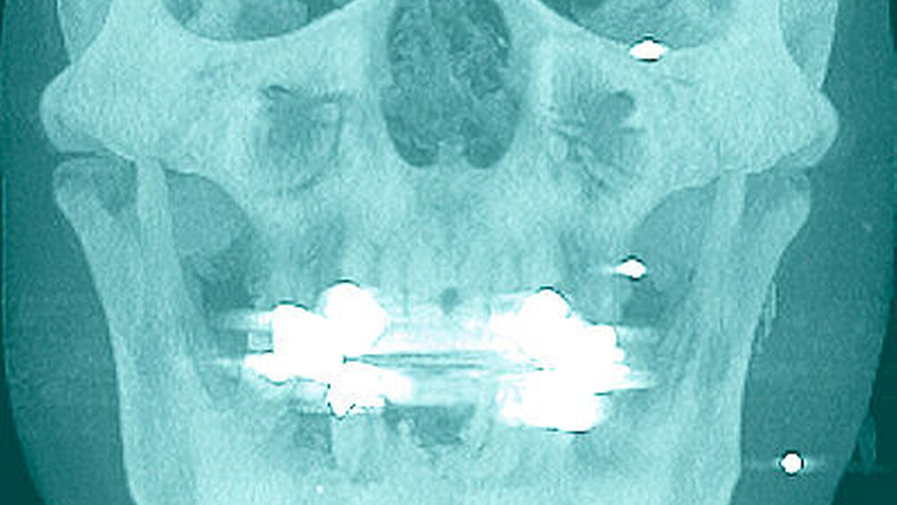Abbildung 5: DVT-basierte Schädel-pa(posterior-anterior)-Projektion: Sequestrierung Unterkieferfront, nebenbefundlich multiple Projektile im Bereich des linken Gesichts/paranasal |