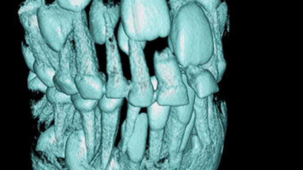 Abbildungen 1 bis 3: Überzähliger Milchzahn 52+ bei einem knapp achtjährigen Knaben mit verzögertem Durchbruch der bleibenden Oberkieferfronzähne. In der digitalen Volumentomografie erkennt man zudem einen überzähligen lateralen Schneidezahn 12+ (3a: 3-dimensionale Bildrekonstruktion, Ansicht von bukkal) |