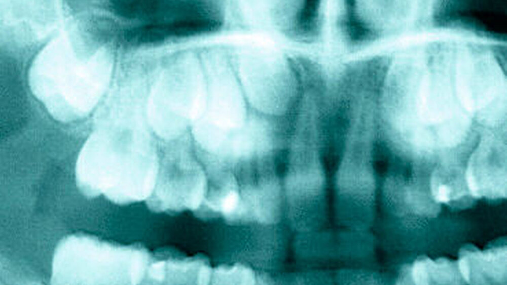 Abbildung 2: Ausschnitt aus dem präoperativen OPTG: Hier zeigt sich eine dezente osteolytische Aufhellung im Sinne eines verbreiterten perikoronaren Raumes um die Krone des retinierten Zahnes 13. |
