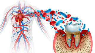 Parodontitis und Herzerkrankungen