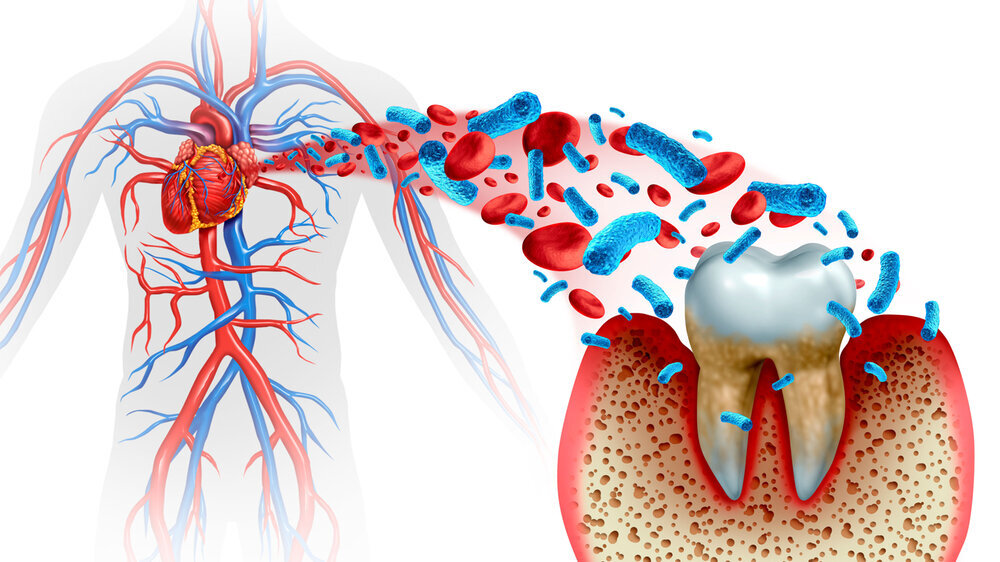 Parodontitis und Herzerkrankungen