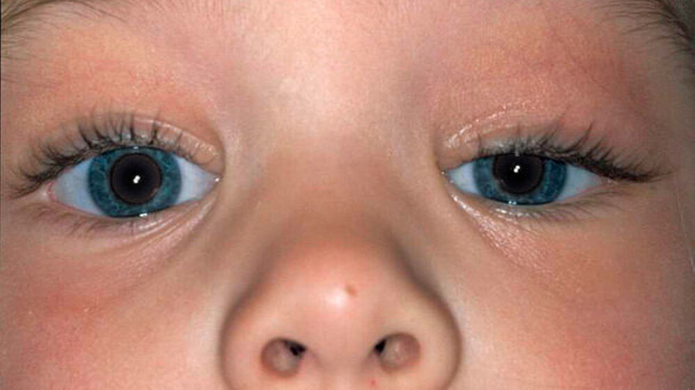 Das Ergebnis unmittelbar nach der Nahtentfernung: Die Funktion des Auges ist wiederhergestellt, die Operation gelungen.