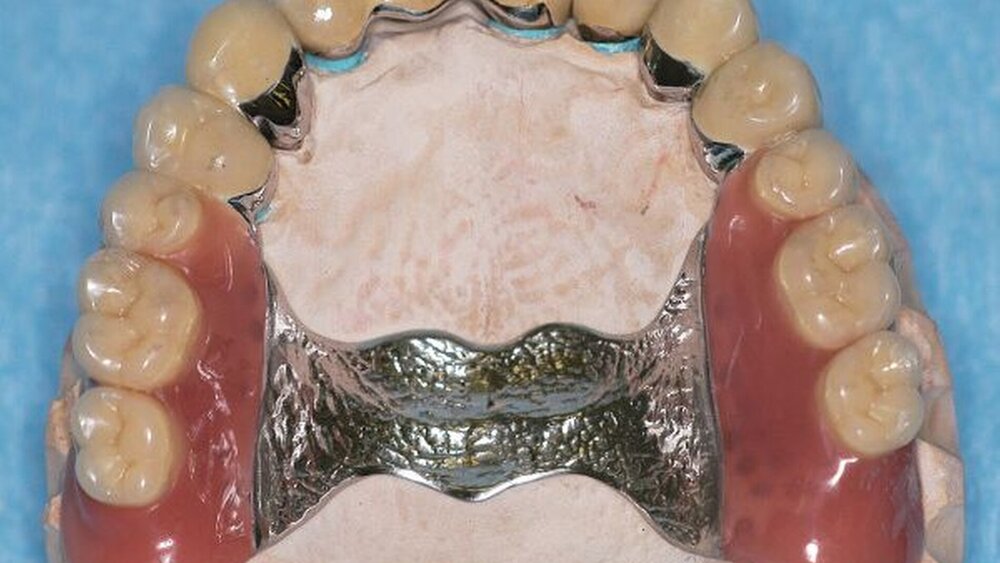 Abbildungen 15a, 15b, 15c: Vollständig verblendete und mit Glasurbrand versehene Kronen und Brücken sowie fertiggestellte partielle obere Prothese vor der definitiven Fixierung. |