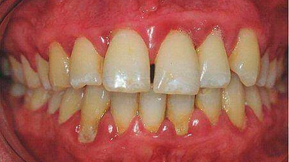 Abb. 1: Parodontitis beeinflusst unter Umständen das äußere Erscheinungsbild und die Kommunikationsfähigkeit eines Menschen. Durch die freiliegenden Interdentalräume in der Oberkieferfront wird zum Beispiel die Lautbildung unter Umständen erheblich