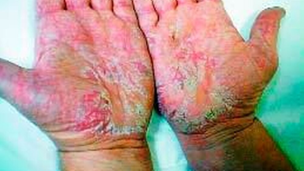 Hauterscheinungen wie diese und andere neurodermitisch bedingte Hautläsionen können heute besser therapiert werden.