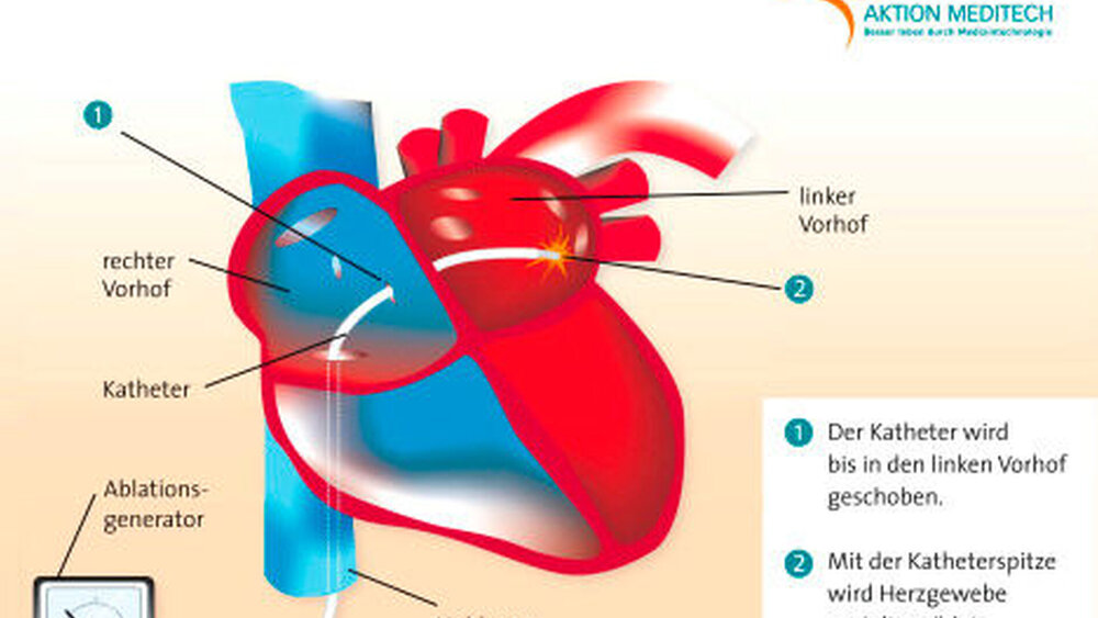 Eine Katheterablation ist indiziert, wenn die elektrische Kardioversion nicht erfolgreich verläuft. |