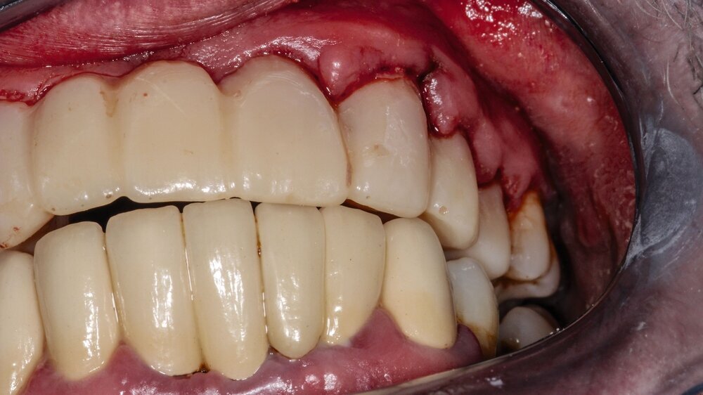 A very bad case of periodontitis Parodontitis