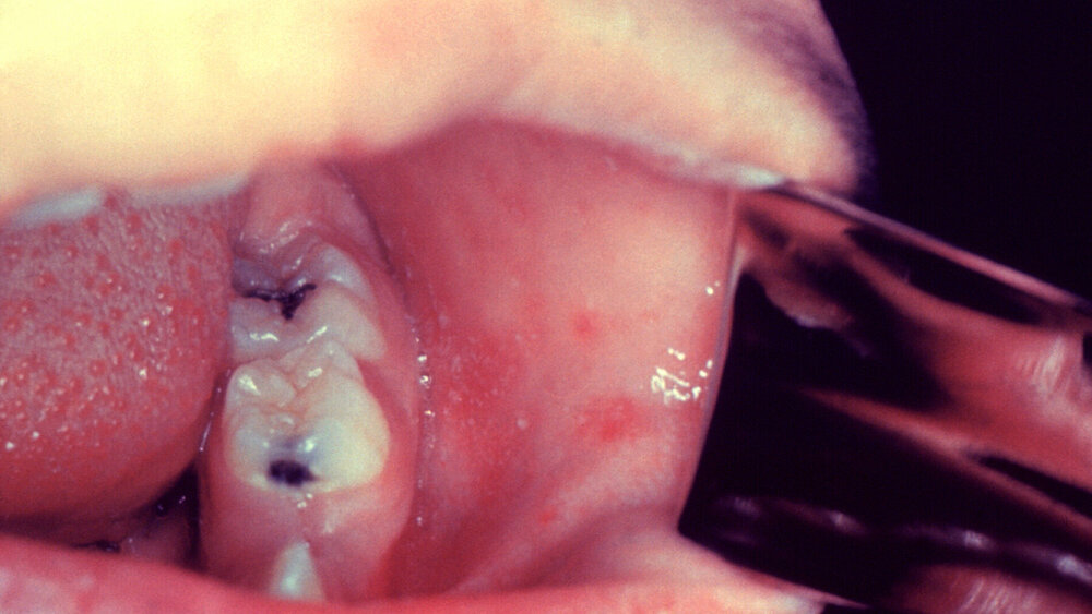 Koplik-Flecken (auch Koplik-Zeichen)