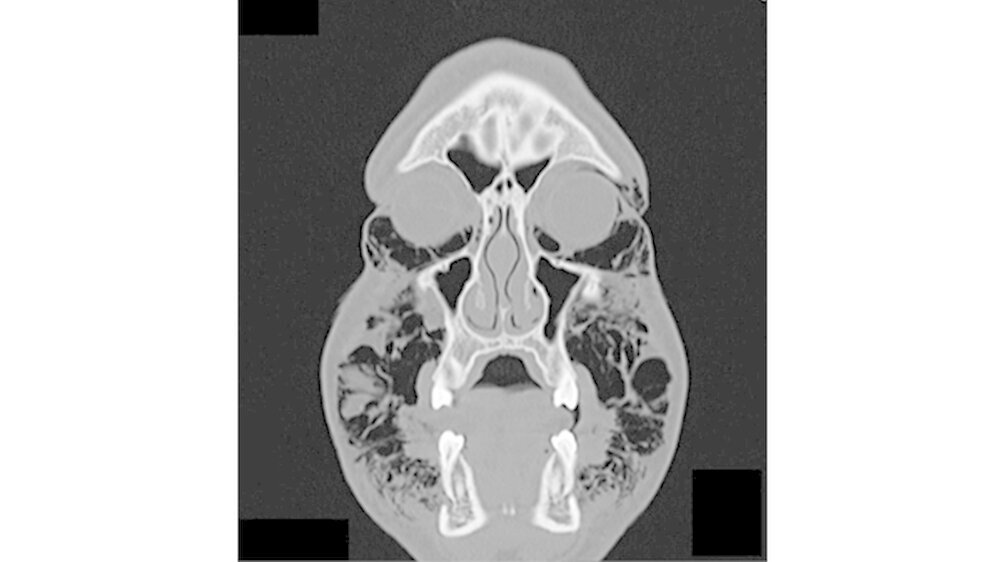 Abb. 3: Die Computertomografie (CT) des Kopf- und Halsbereichs zeigte eine bilateral subkutane Luftsammlung im Bereich der periorbitalen und der paramandibulären Region. Der CT-Scan zeigt mehrere Lufteinschlüsse innerhalb des Gesichtsweichgewebes. Es ga