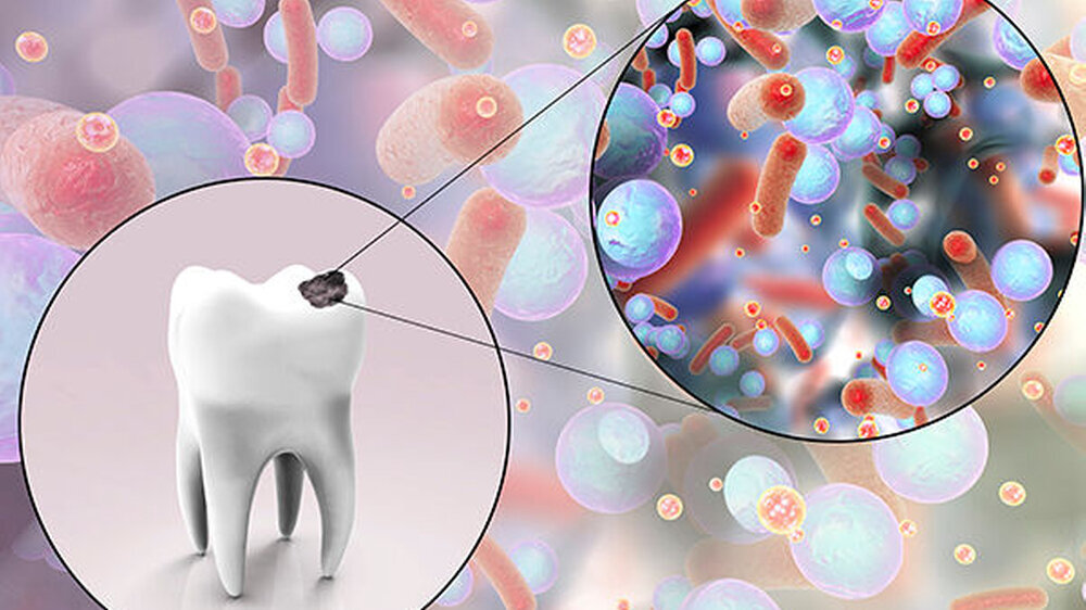 Was etablierten Forschern bislang nicht gelang, haben sie in nur einem Jahr geschafft: US-Studenten haben die Genome von vier Stämmen des Karieserregers Streptococcus sobrinus sequenziert.