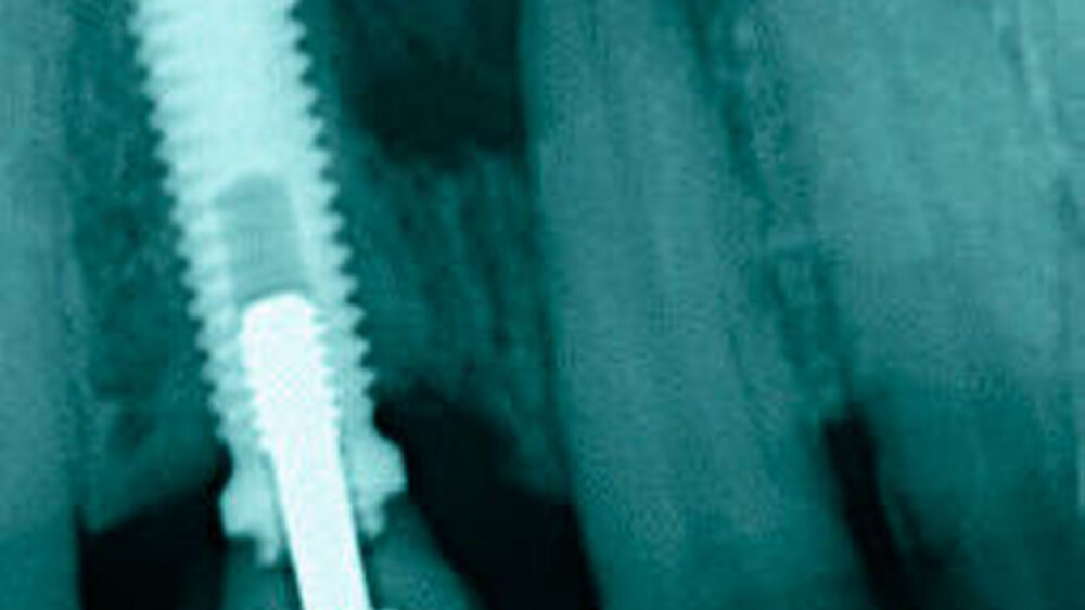 Abbildung 1: Diagnostischer Zahnfilm Auf dem diagnostischen Zahnfilm sieht man eine etwa 1 x 1 cm große apikale Transluzenz in Regio 21 mit Ausdehnung bis zum Implantat in Regio 11. |
