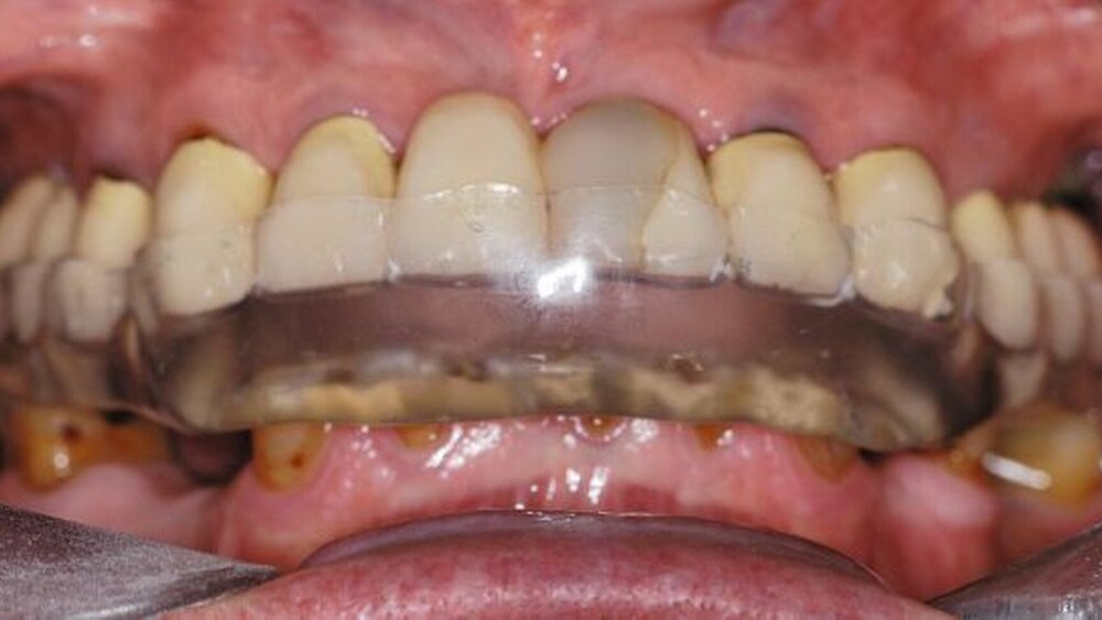 Abbildung 11: Nach Eingliederung der Stabilisierungsschiene zeigt sich deutlich die Diskrepanz zwischen aktueller und ermittelter vertikaler Kieferrelation. |