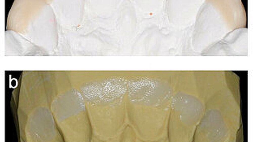 Abbildung 6: a: Aufgewachste Inzisalkanten auf dem Modell, b: Auf dem Modell hergestellter Silikonschlüssel, mit Komposit-Schmelzmasse gefüllt zum Aufbau der inzisal-palatinalen Restaurationsanteile |