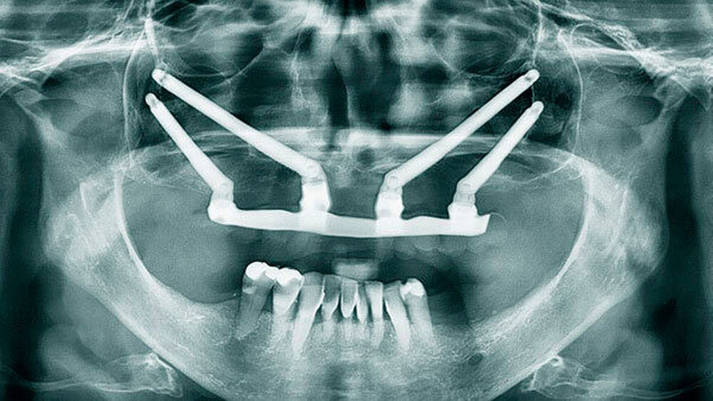 Abbildung 3: Röntgenkontrolle ein Jahr nach Implantation. Die Implantate erscheinen unauffällig. |
