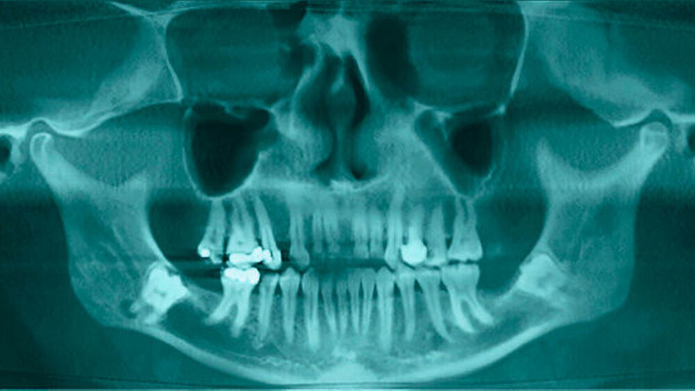 Abbildung 2: Rekonstruktion der Panoramaschichtaufnahmenansicht der präoperativen digitalen Volumentomografie |