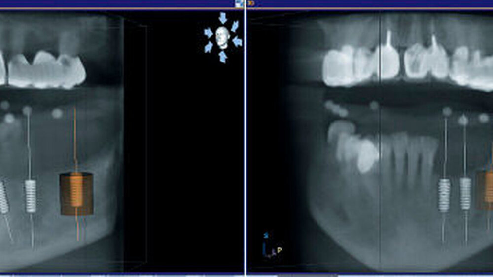 Abbildung 7: Virtuelle Planung der Implantatposition am PC unter Verwendung einer individuellen Röntgen-Schablone, die später zu einer Bohrschablone umgearbeitet wird. |