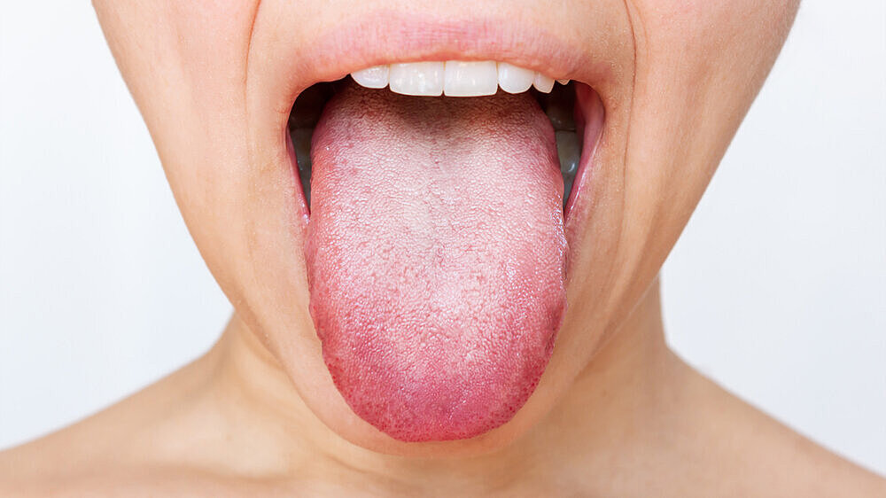 Female tongue with a white plaque. Cropped shot of a young woman showing tongue isolated on a white background. Digestive tract disease, organ dysfunction, poor oral hygiene, fungal infections Female tongue with a white plaque. Cropped shot of a young woman showing tongue isolated on a white background. Digestive tract disease, organ dysfunction, poor oral hygiene, fungal infections