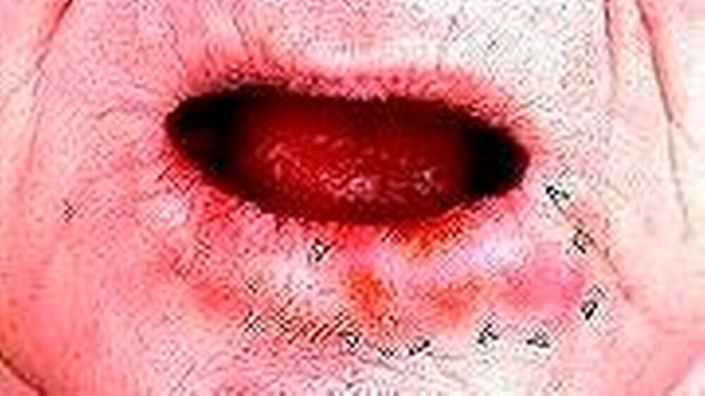 Abbildung 1: Ausgangsbefund einer knotigen Auftreibung der gesamten linken Unterlippe. Der Tumor liegt unmittelbar subcutan/submucös, durchbricht aber zu diesem Zeitpunkt die Haut beziehungsweise Schleimhaut nicht.
