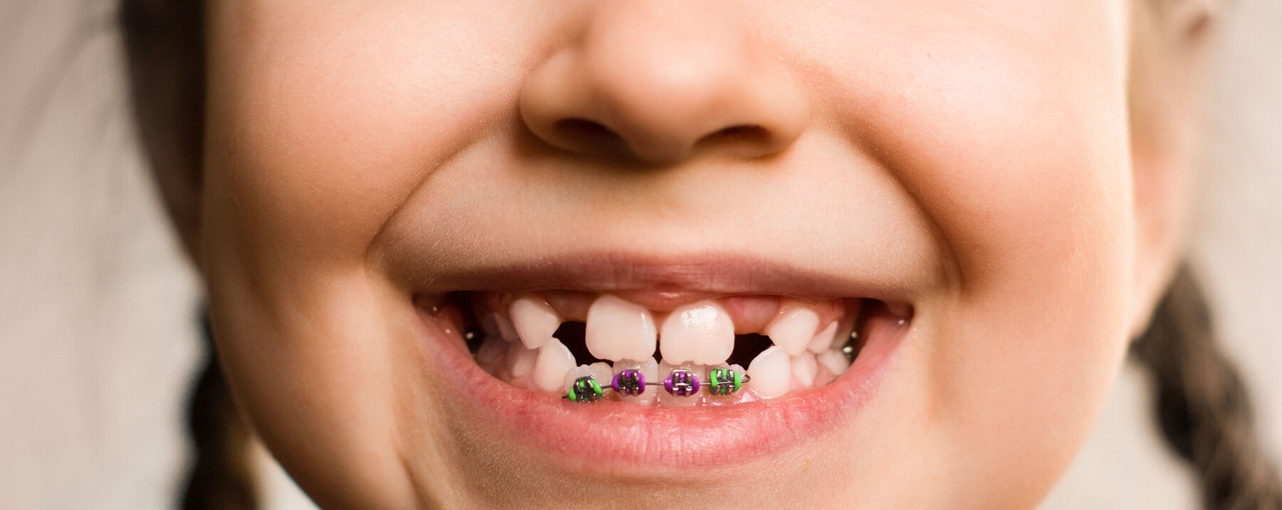 Mädchen mit Brackets