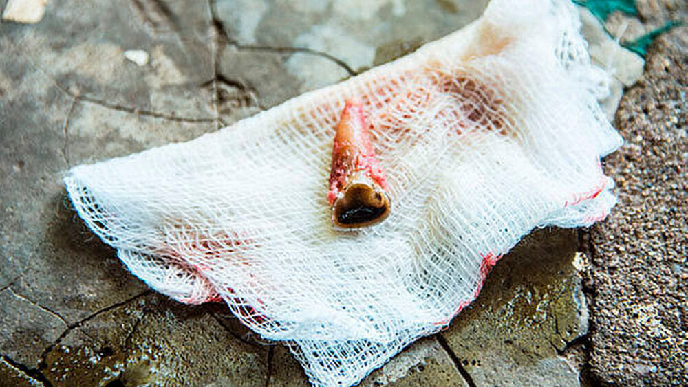 Eine Fistel an Georges Unterkiefer war die Ursache, weshalb der Zahn extrahiert werden musste. |