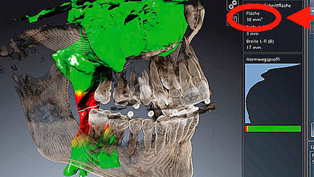 Abbildung 4a: Die oberen Luftwege in volumentomografischer 3-D-Darstellung mit quantitativer und qualitativer Vermessung. |
