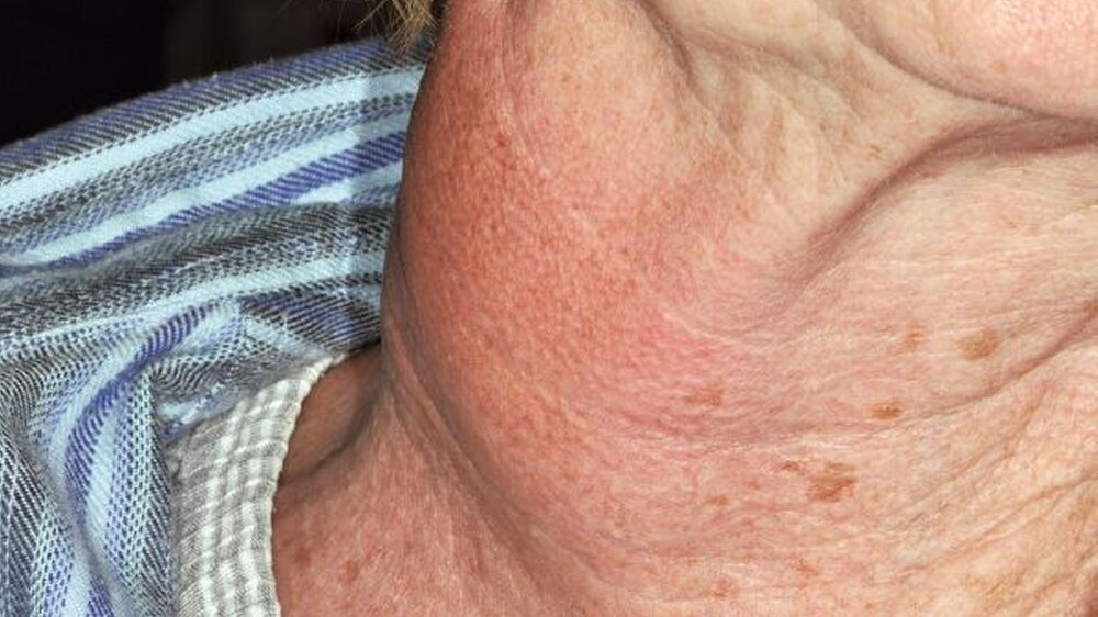 Abbildung 1: Klinischer Aspekt der Patientin. Etwa 4 x 4 x 4 cm großer, nicht druckschmerzhafter und zur Unterlage adhärenter, derber Tumor cervical rechtsseitig.