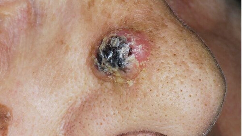 Abbildung 1: Klinischer Aspekt des Tumors in der Übersicht (a): Es zeigt sich ein exophytisch wachsender Hauttumor mit einem zentralen Hornpfropf und einer prominenten Randwallbildung der Oberfläche.