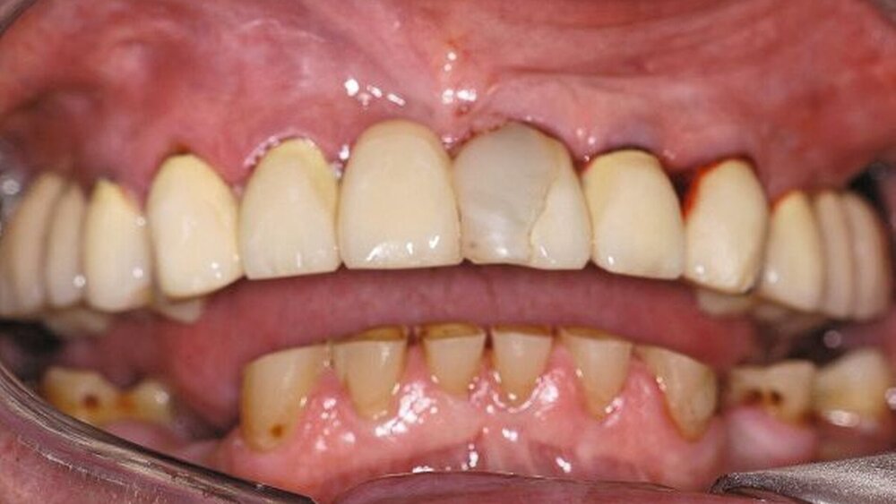 Abbildungen 1a, 1b, 1c: Beim Zubiss zeigt sich die zu geringe vertikale Kieferrelation bedingt durch hochgradig abradierte Zähne (besonders im Unterkiefer). |