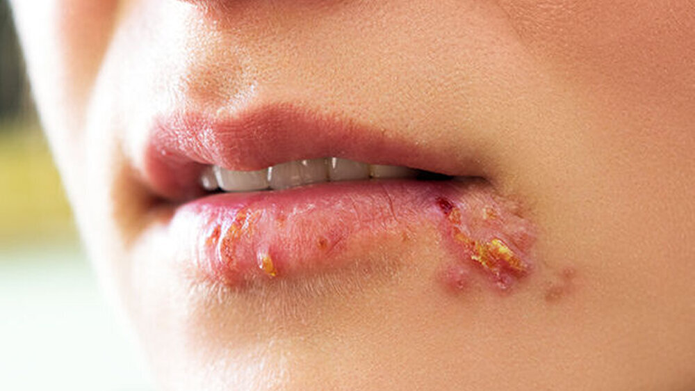 Bisher sind acht verschiedene Herpesviren bekannt, die den Menschen befallen. Sie bleiben nach der akuten Infektion dauerhaft im Körper. Aus dieser Ruhephase können sie unter bestimmten Umständen „aufwachen”, sich vermehren und wieder weitere Zelle
