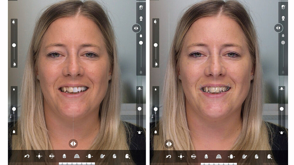 Abbildungen 1 und 2: Mit einer videogesteuerten Software lassen sich Behandlungsergebnisse realistisch simulieren. Ausgangsbefund und Wunschergebnis werden über eine Sliderfunktion visualisiert (linkes Bild).
