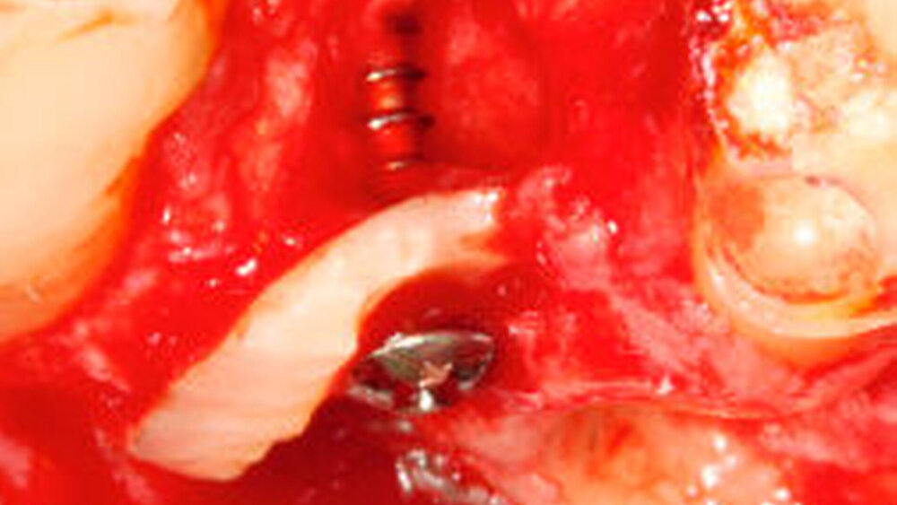 Abbildung 6c: Direkte Augmentation eines bukkalen Dehiszenzdefekts im Alveolenbereich unter Verwendung eines separierten Wurzelfragmentes des extrahierten Zahns. |